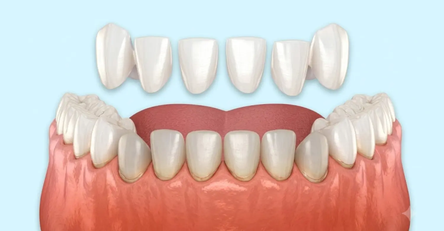 Porcelain Veneers Cost Comparison 2